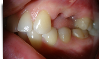 most adhezyjny - brak dwóch zębów